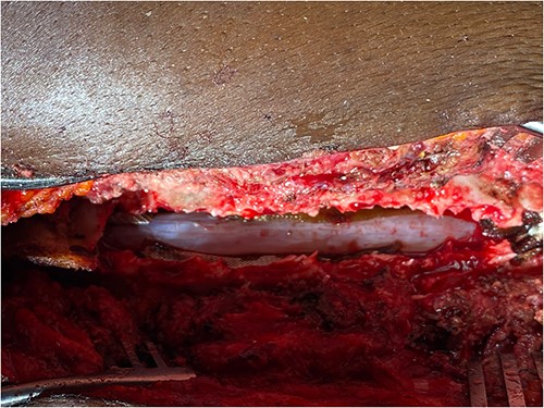 Cyst completely disconnected and excised.