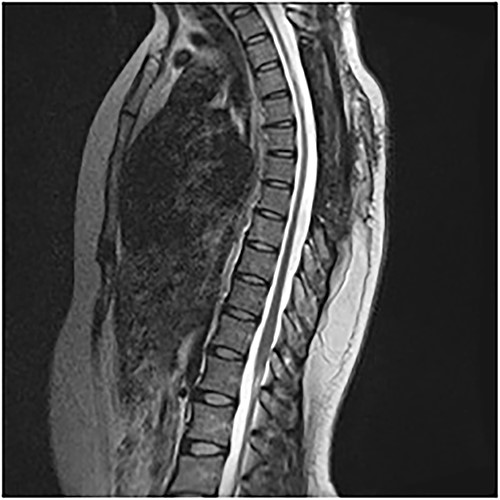 Postop sagittal.