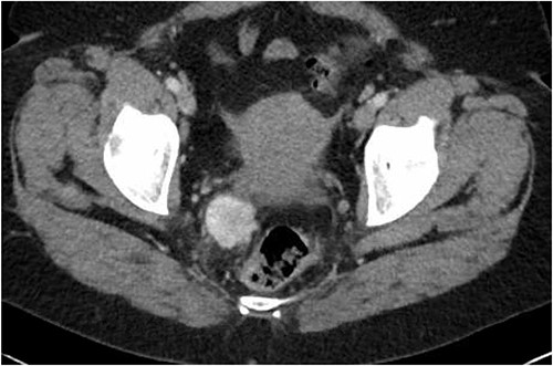Latest CT evaluation prior to consultation, showing a right pararectal hypervascular mass.