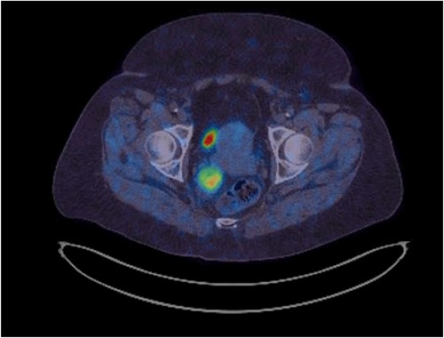 Hypersignal on Gallium-68 Dotatate PET scan (SUVmax 9.4).
