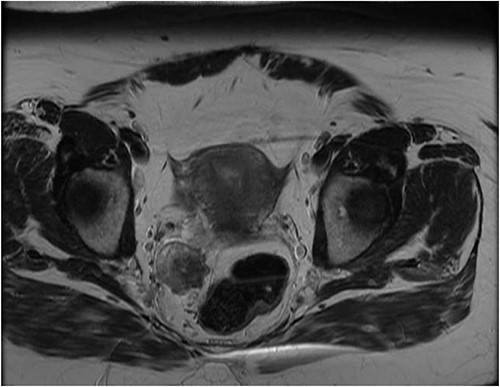 Latest pelvic MRI on initial consultation (T2-weighted images).