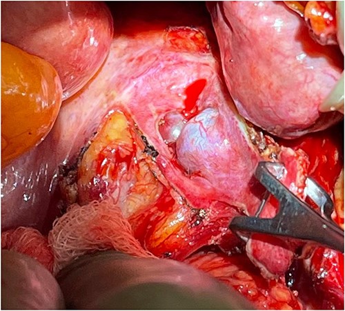 Perioperative location of the tumor, as the rectum is being retracted to the left (by hand).