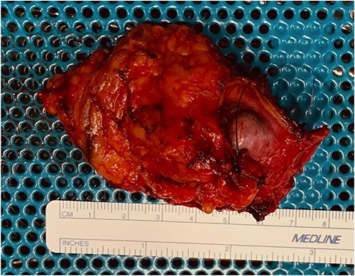 Macroscopic examination of the excised pararectal mass.