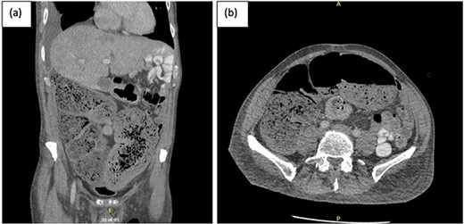 (a) Coronal and (b) axial views of CT abdominal pelvis, with oral and intravenous contrast demonstrating significant faecal loading in ascending colon and proximal to mid-transverse colon.