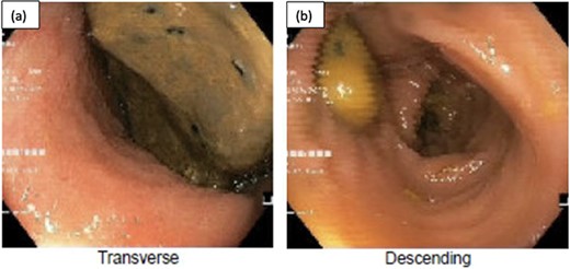 Flexible sigmoidoscopy demonstrating distended (a) transverse and (b) descending colon with faeces in the lumen and no mucosal changes to suggest ischaemia or inflammation.
