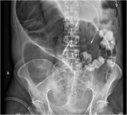 Gastrograffin study demonstrating markedly dilated gas filled loop of large bowel seen extending from the pelvis into the right upper quadrant, consistent with a dilated loop of redundant sigmoid, with no obvious contrast in the colon but some contrast in the small bowel loops in the left upper quadrant.