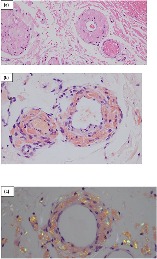 Surgical pathology of tissue. (a) Arteries within the bowel wall show marked circumferential thickening by amorphous eosinophilic material consistent with amyloid. H&E, original magnification ×200. (b) Congo red stain showing positive staining within the blood vessel wall consistent with AL. Congo red, original magnification ×200. (c) Congo red stain showing green birefringence under polarized light. Congo red with polarisation, original magnification ×200.