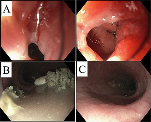 Initial post-op endoscopy, GE circumferential mass (A), esophageal dilation (C), with retained material (B).