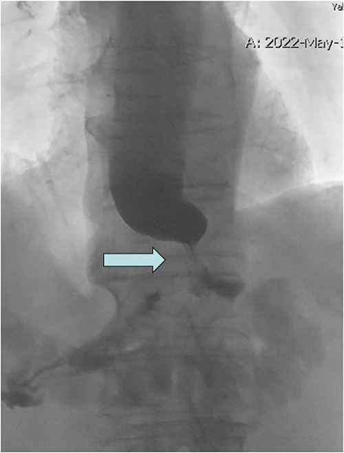Upper GI fluoroscopy with tight GE junction stricture (arrow) and holdup of contrast.