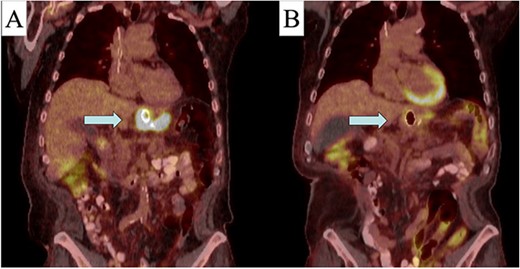 Pre (A) and post (B) initial treatment PET-CT with response to neo-adjuvant therapy (area indicated by arrow).