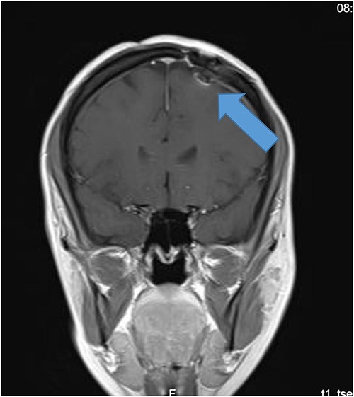 Preoperative CT of the brain.