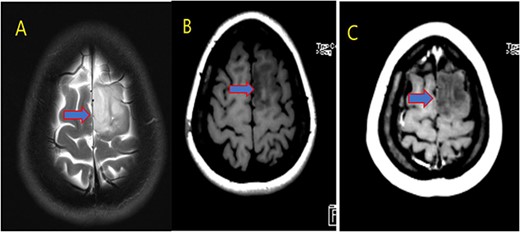 MRI brain with contrast; (A) T2, (B) T1, and (C) T1 post contrast; space occupying cortical mass lesion in the left frontal lobe/superior frontal gyrus showing mild faint minimal contrast enhancement (C) (low-grade glioma).