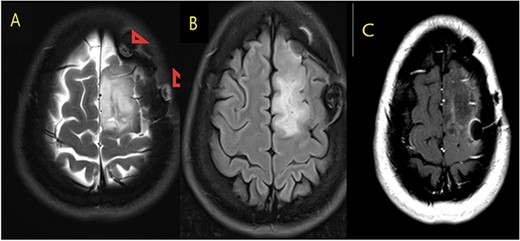 MRI brain with contrast (A) T2, (B) FLAIR, and (C) T1 postcontrast; in comparison to the fore mentioned study; still noted postoperative changes in the form of craniotomy (regression of size of space occupying cortical mass lesion with mild surrounding vasogenic edema in the left frontal lobe/superior frontal gyrus).
