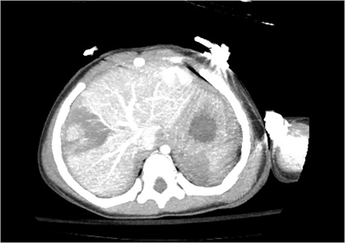 Axial view of CT image revealing liver and splenic injuries.