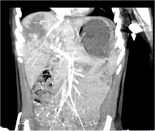Coronal view of CT image revealing liver and splenic injuries.