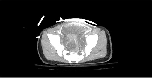Bladder hematoma adjacent to pubic ramus fracture.