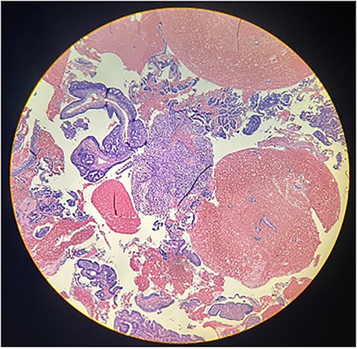 Photomicrograph shows the presence of a malignant mixed tumor containing epithelial and sarcomatous components (H&E stain ×4).