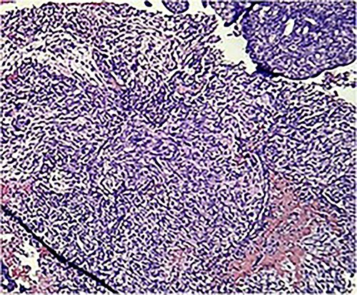 Photomicrograph shows homologous sarcomatous components, composed of sarcomatous spindle shaped cells, with elongated nuclei and irregular nuclear membrane. (H&E stain ×10).