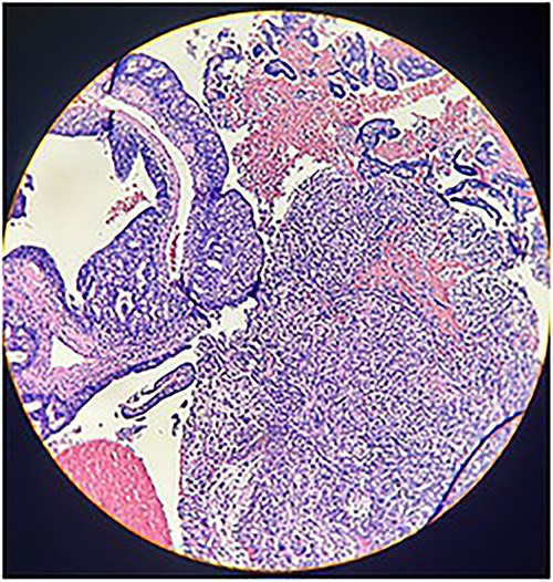 Photomicrograph shows epithelial components that form atypical glands and solid nodules with a sarcomatous component (H & E stain ×10).