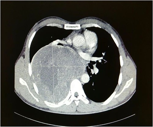 Axial cut of a contrasted CT Thorax depicting a large right posterior mediastinal mass.