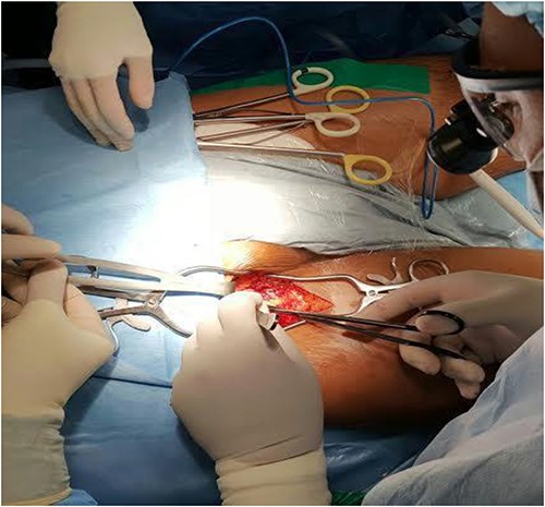 Right femoral-femoral access for cardiopulmonary bypass.
