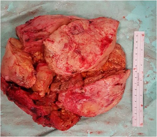 A photo micrograph of the surgical specimen removed.