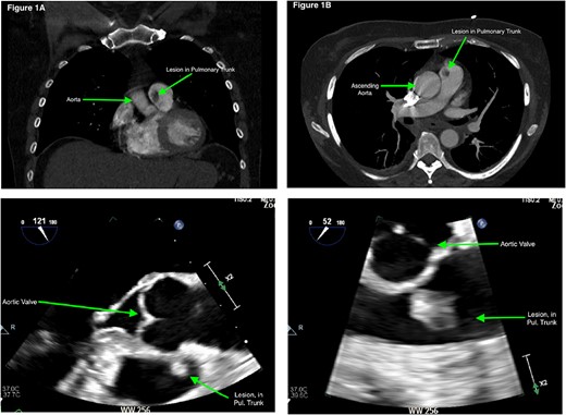 (a) and (b) Computerized tomography scan (coronal and axial slices) demonstrating filling defect in the pulmonary trunk. (c) and (d) TOE images of the PV lesion.