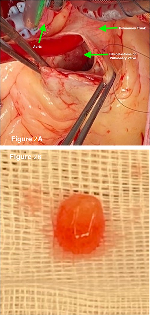 (a) Intraoperative imaging demonstrates the gelatinous lesion on the leaflet of the PV after opening the pulmonary trunk. (b) Excised PV papillary fibroelastoma.