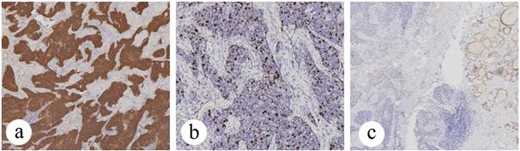 Patient no. 1 (a) tumor cells are positive for CK5/6, (b) tumor cells showed 20% positivity for Ki67, SP × 10, and (c) tumor cells showed negativity for TTF-1, SP × 4.