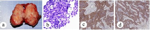 Patient no. 2 (a) operative specimen, (b) FNAC shows nest-like small round tumor cells, (c) tumor cells are positive for CD5, SP × 10, and (d) tumor cells are positive for CD117, SP × 4.