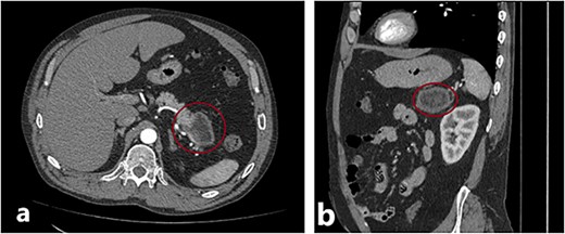 (a) and (b) Axial and sagittal CT images showing a distal pancreatic tumor.