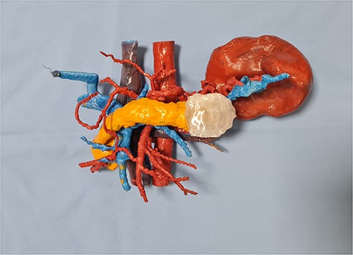 The 3D printed replica of the patient’s anatomy.