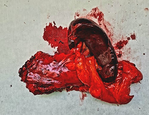 The resected specimen—distal pancreas and spleen with lesion in the middle of the specimen.