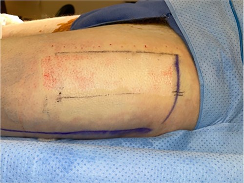 Intraoperative donor site following skin graft harvesting.