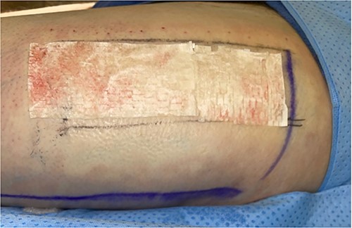 Intraoperative donor site covered with 7 × 10 cm UBM (Acell Lafayette).