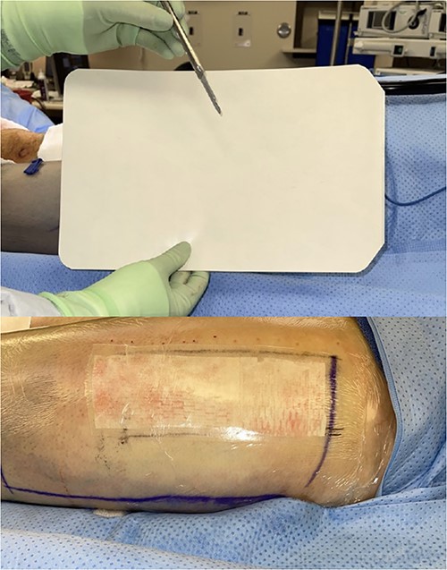 Intraoperative donor site covered with perforated Tegaderm™.
