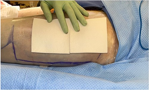 Intraoperative donor site covered with Drawtex®.