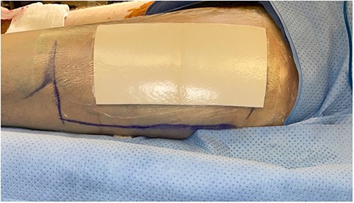 Intraoperative skin graft donor site with dressings in place.