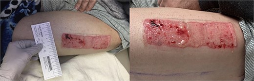 Healing donor site postoperative day 7.