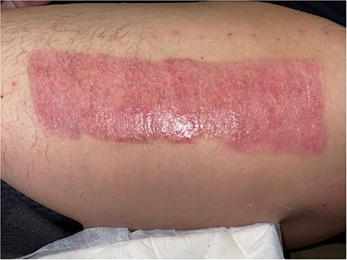 One-month postoperative healing donor site.