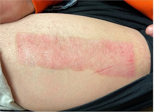 Two-month postoperative healed donor site.