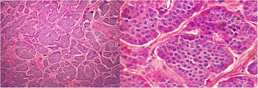 Well differentiated NETs involving mucosa, submucosa, muscularis propria of jejunum at 200× (left) and 600× (right) magnification.