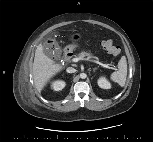 CT abdomen and pelvis with IV contrast demonstrating a complex fluid density with gaseous foci occupying the gallbladder fossa and measuring 6.5 cm × 5.8 cm × 5.5 cm.