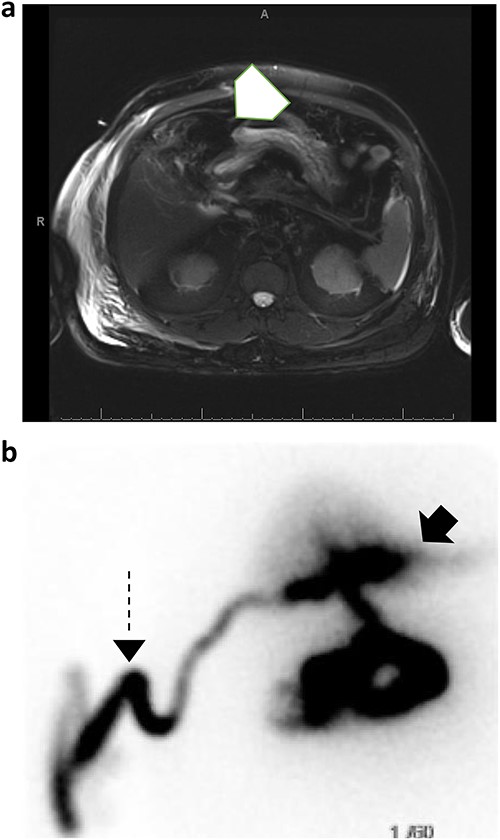 (a) MRCP with and without IV contrast identifies trace free fluid in gallbladder fossa (white arrow); (b) subsequent HIDA scan confirms right hepatic subcapsular bile leak (black arrow) adequately drained by percutaneous catheter (dashed arrow).
