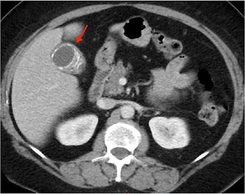 Semi-annular wall calcification at the gallbladder body—axial view.
