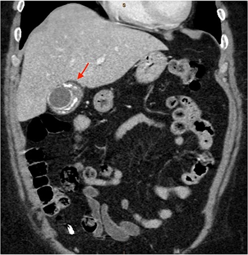 Semi-annular wall calcification at the gallbladder body—coronal view.