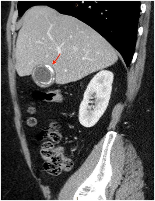 Semi-annular wall calcification at the gallbladder body—sagittal view.