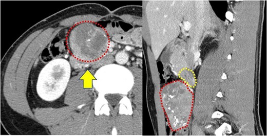 (a) Contrast-enhanced computed tomography reveals a well-defined heterogeneous enhancement mass with calcification (red dotted box); the mass is present on the ventral ileocolic vessels (yellow arrow); (b) the transverse duodenum (yellow dotted box) is pushed by this tumor (red dotted box).