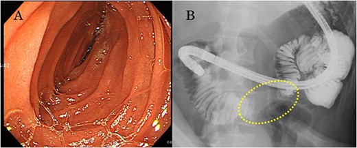 (a) Esophagogastroduodenoscopy reveals no lesion in the duodenal lumen, but the transverse duodenum is pushed by the mass from outside the lumen; (b) upper gastrointestinal examination illustrates that the transverse duodenum is pressed by the mass palpable outside the body of the patient.