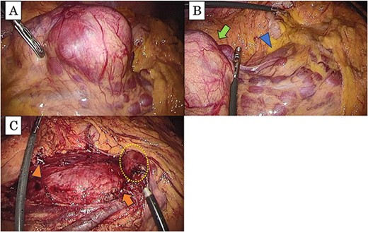 (a) The tumor is present in the right mesocolon; (b) there is no invasion from the tumor (arrow) to the duodenum (arrowhead); (c) this intraoperative image, which has resected the tumor, shows the periphery of ileocolic vessels (arrow head) and the root of the vessels (arrow); the duodenum is not damaged (dotted box).